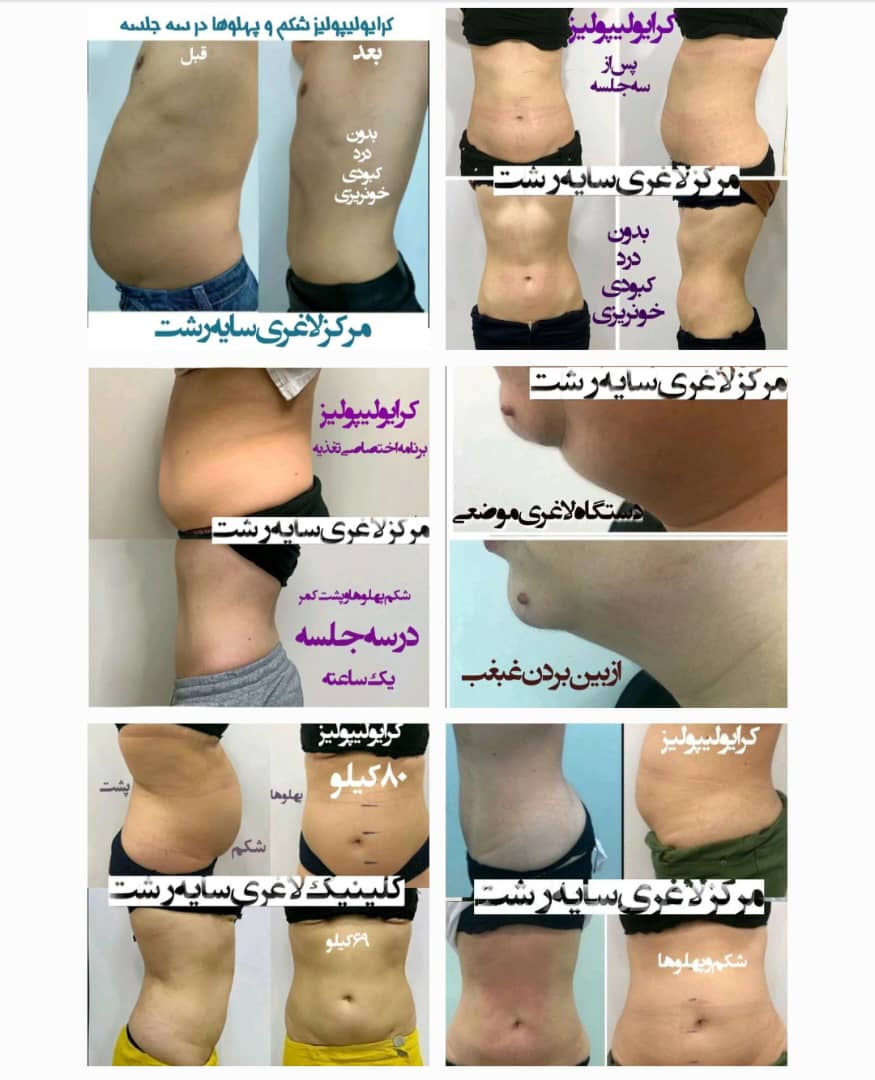 کلینیک لاغری تضمینی سایه کاهش سایز سریع در رشت